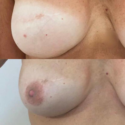 Dermopigmentazione-paramedicale-vderma