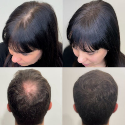 Tricopigmentazione-VDERMA Cassino