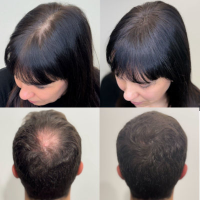 Tricopigmentazione-VDERMA