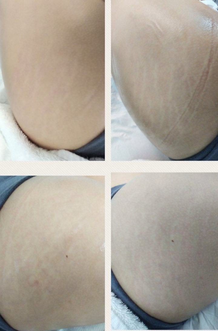 centro-cassino-frosinone-vderma-rimozione-smagliature