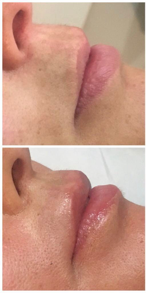 dermopigmentazione-cassino-frosinone-vderma-labbra-2