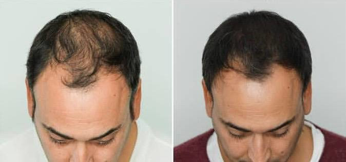 tricopigmentazione-cassino-frosinone-vderma-capelli